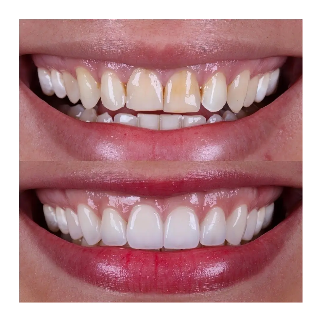 teeth veneers best results are shown 